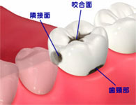 虫歯の範囲が小さい場合