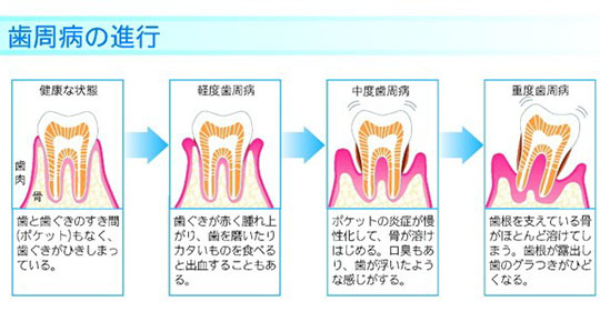 歯周病の進行と症状