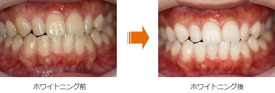 ホワイトニング症例