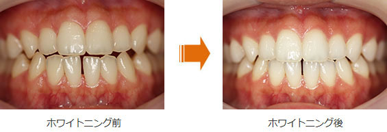 ホワイトニング症例